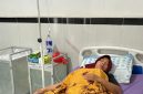 Nur Aisyah (40) saat menjalani perawatan di Klinik Bunda Tika, Desa Pemulihan, Kecamatan Way Sulan, Kabupaten Lampung Selatan, Minggu (5/7/2026).  (Doc. Lilis)